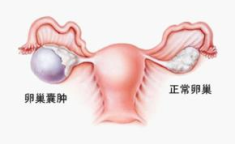 卵巢囊肿症状,了解身体发出的健康信号